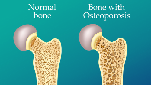 The Latest Osteoporosis Seminar: Bone and Muscle Interactions by Dr. Ramin Heshmat